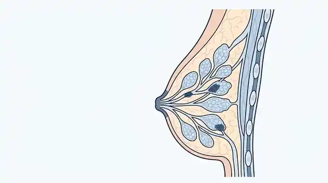 Anatomía de la mama con lóbulos, conductos y sitio de origen del carcinoma mamario.