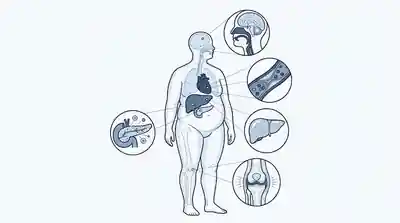 Ilustración de complicaciones sistémicas de la obesidad en cerebro, hígado, páncreas, articulaciones y otros órganos.